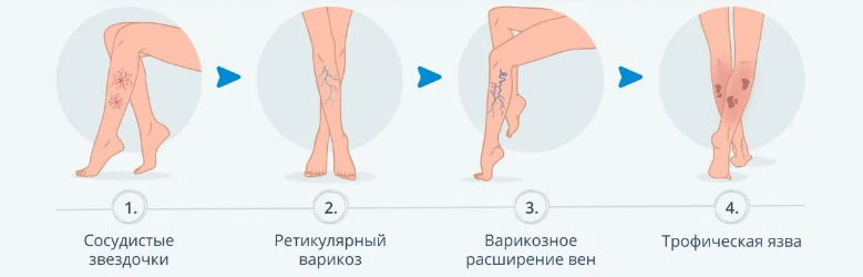 The surgical treatment of relapses of small pelvis varicosis